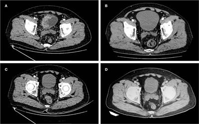 Case report: Bladder preserving after maximal transurethral resection of the bladder tumor combined with chemotherapy and immunotherapy in recurrent muscle-invasive bladder cancer patients: A report of two cases